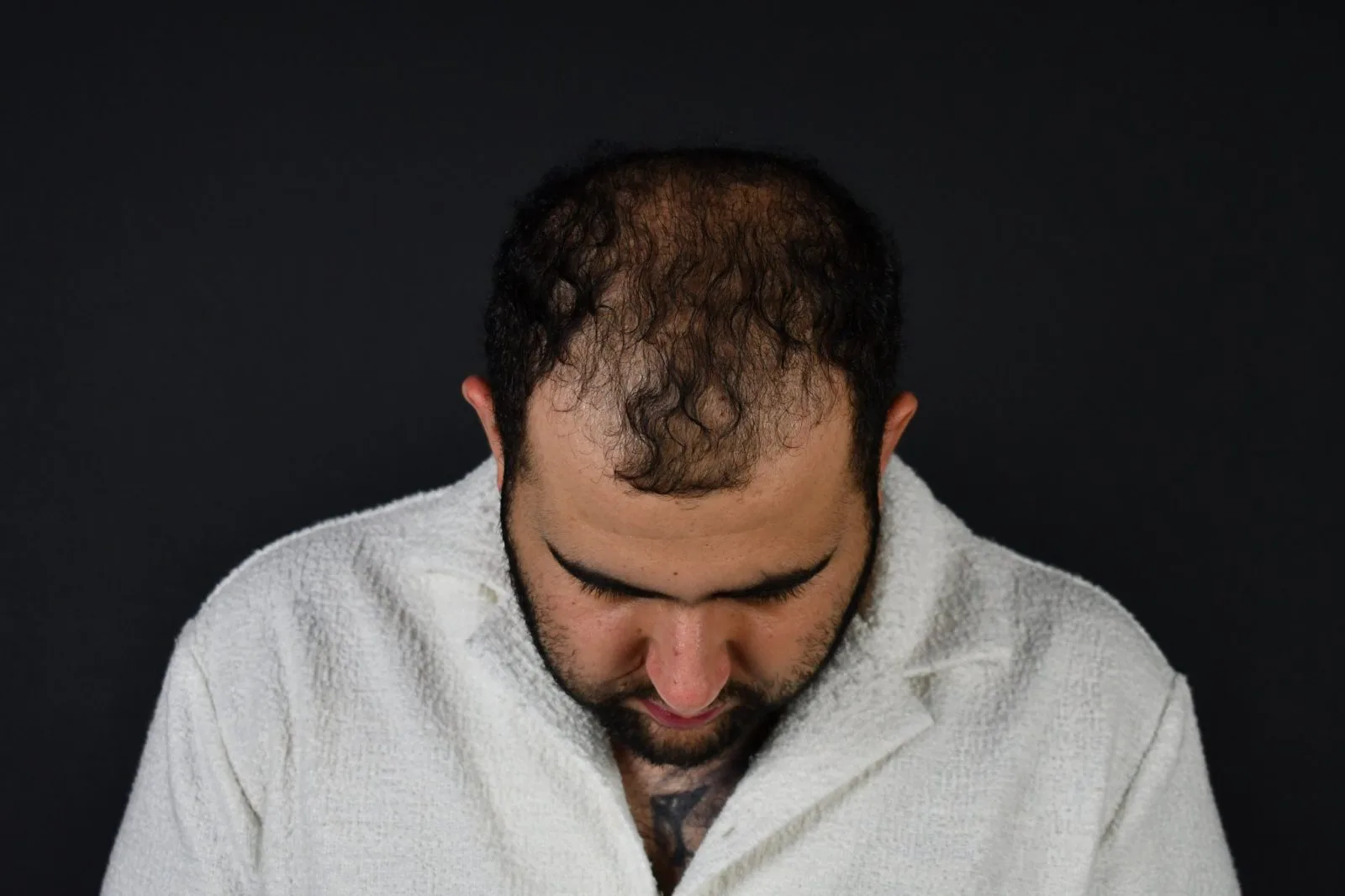 Man with receding hairline shown from behind against dark background